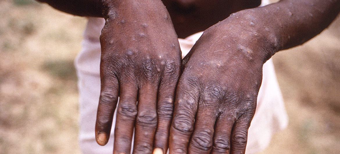 Diseases